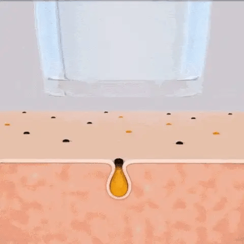 Mee-eter verwijderaar met camera