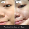 Pimple Patches