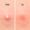 Pimple Patches