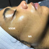 Ultrasone Haarverwijdering SILKYFLASH+