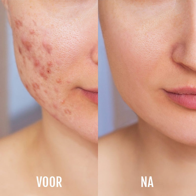 Lichttherapie & acne-apparaat DermaClear