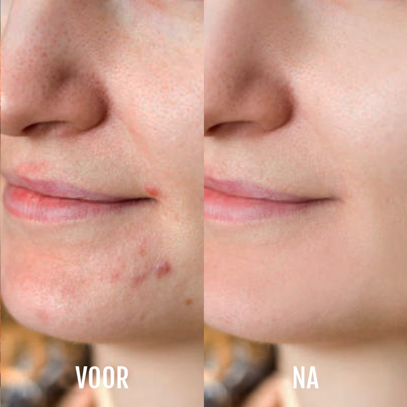 Lichttherapie & acne-apparaat DermaClear