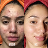 Lichttherapie & acne-apparaat DermaClear
