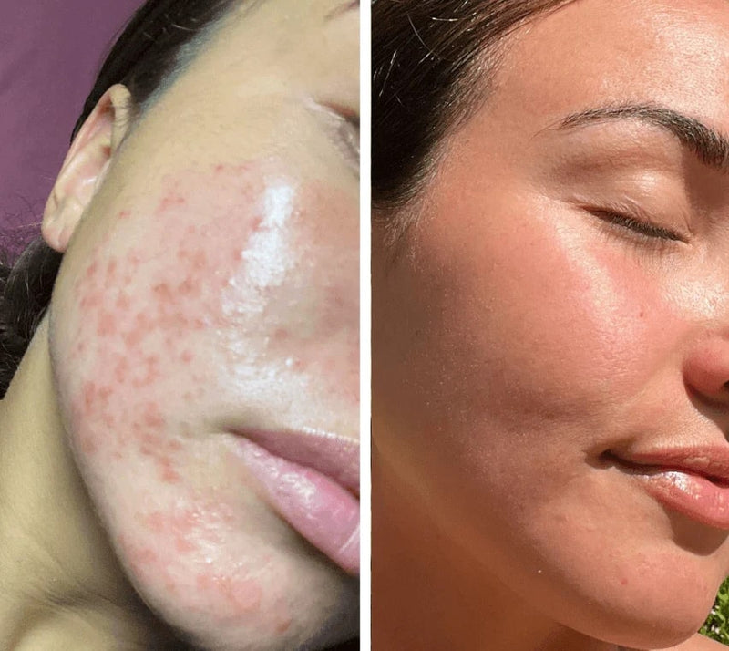 LED Licht Therapie Gezichtsmasker