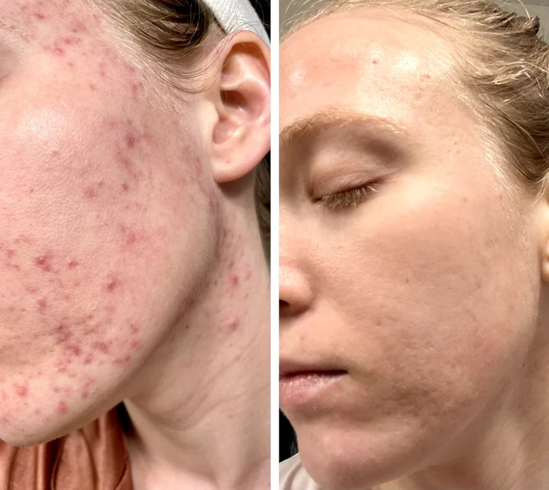 LED Licht Therapie Gezichtsmasker